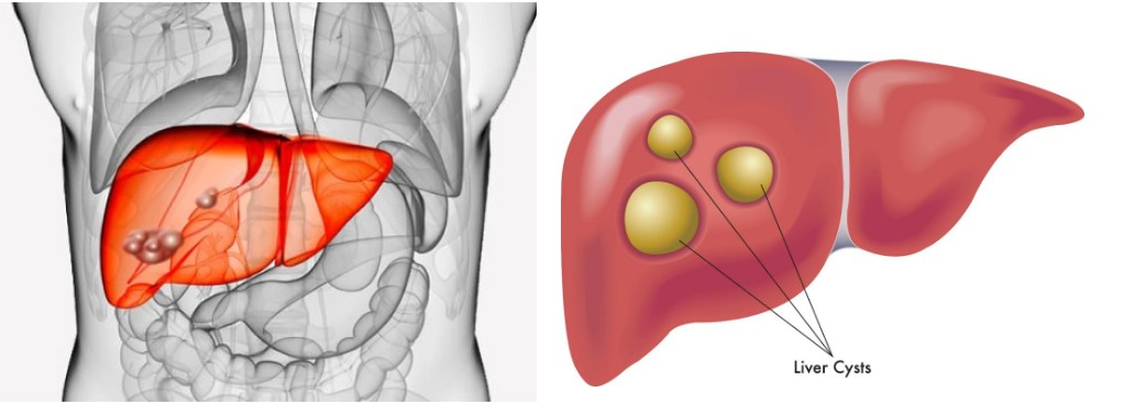 Киста печени у взрослых