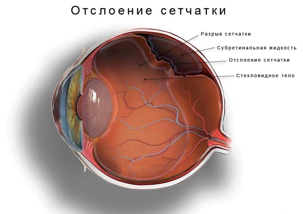 От чего может быть отслоение сетчатки в минске