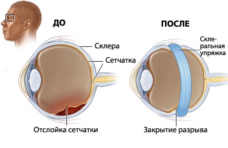 Лечение отслоения сетчатка глаза в беларуси
