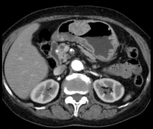 Компьютерная томография определяет рака желудка