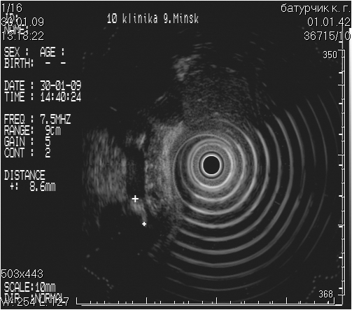 Эндосонография показания. Эндосонография желудка. Холедохолитиаз эндосонография. Эус желудка