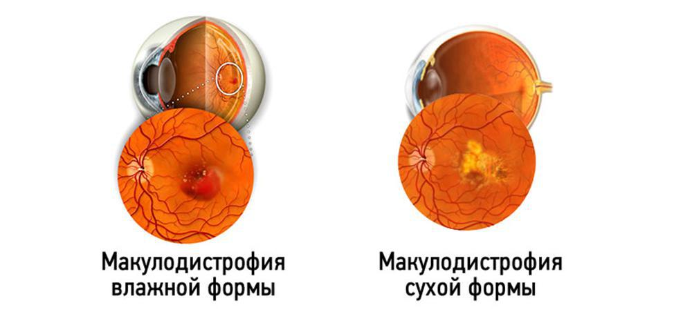 лечение возрастной макулярной дегенерации