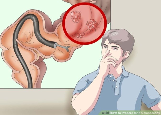 colonoscopy wiki)