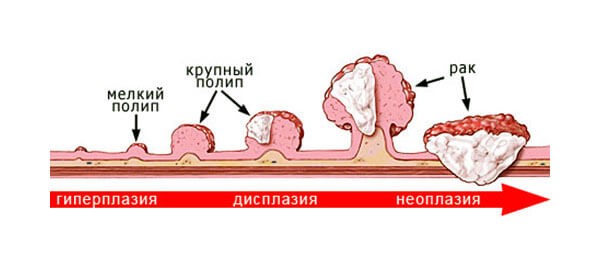 Как выглядит рак папилломы Рак кожи: меланома, базалиома и другие 1 Августа 2018 Земля Хроники жизни