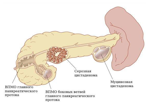Кистозные образования поджелудочной железы. Киста поджелудочной железы мкб. Кистозная опухоль поджелудочной железы. Опухолевидное образование поджелудочной железы. Кистозно расширенные железы