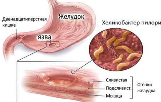 Луковица Двенадцатиперстной Кишки Где Находится Фото