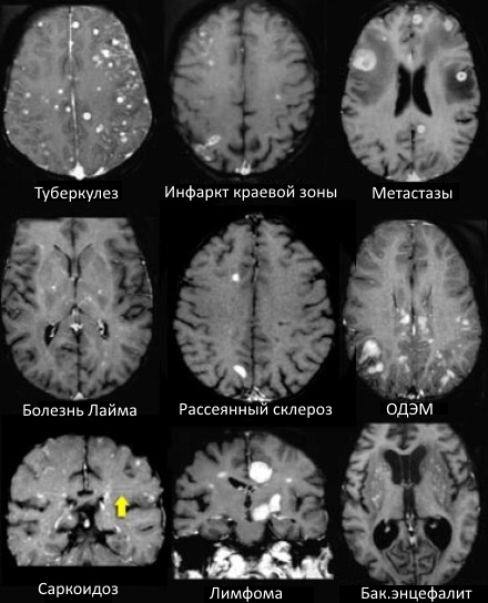 Поражения белого вещества головного мозга на мрт thumbnail