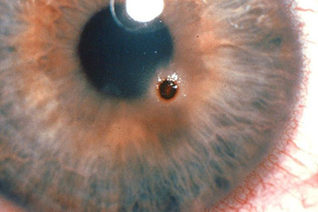 Изменение зрения в результате травмы глаз