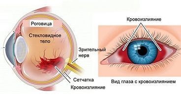 Артериальное давление и орган зрения 08