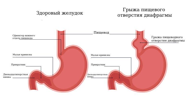 Рентгеновская диагностика и классификация грыж пищеводного отверстия диафрагмы 01
