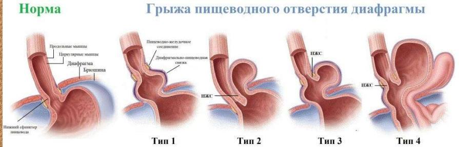 Рентгеновская диагностика и классификация грыж пищеводного отверстия диафрагмы 03
