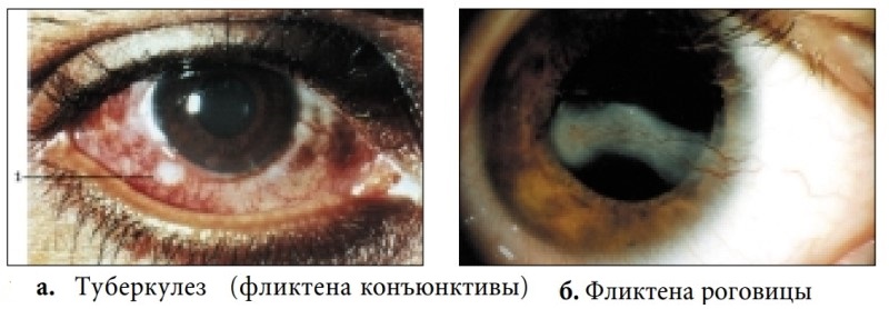 болезни глаз 10