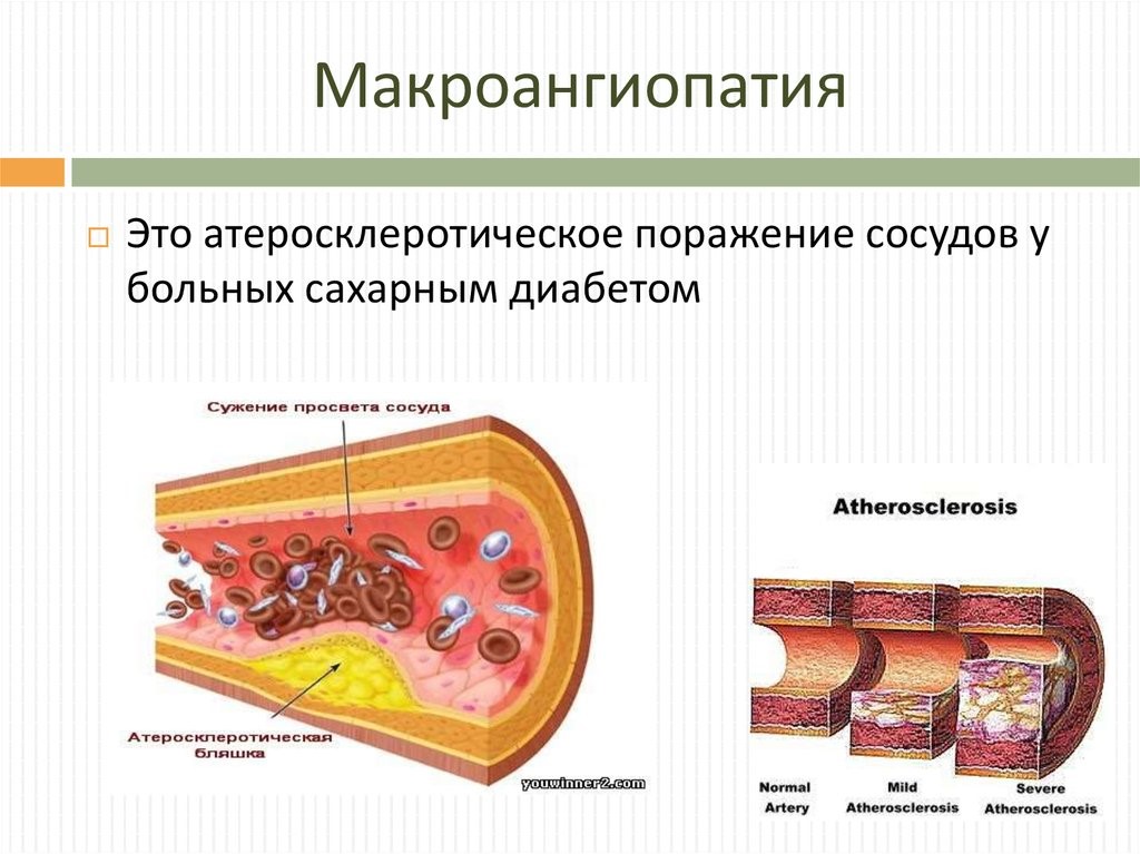 влияние диабета на зрение 2