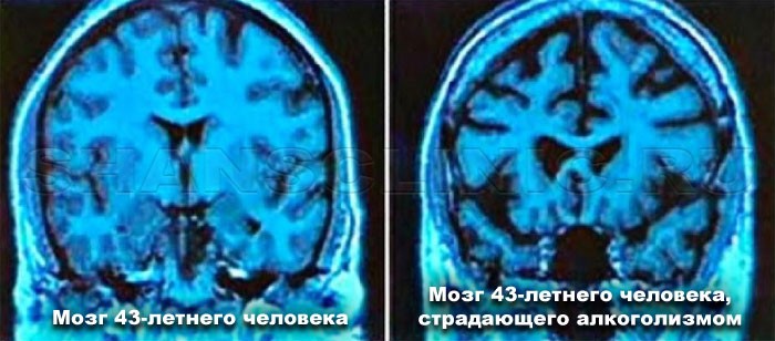 вред алкоголя 3