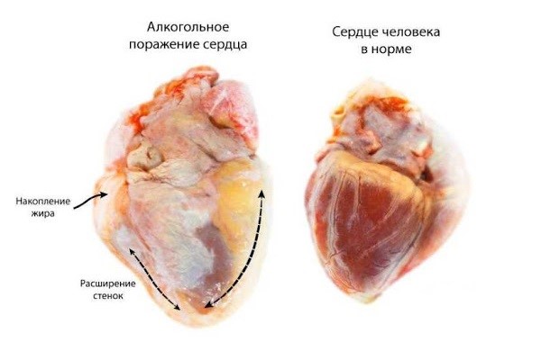 вред алкоголя