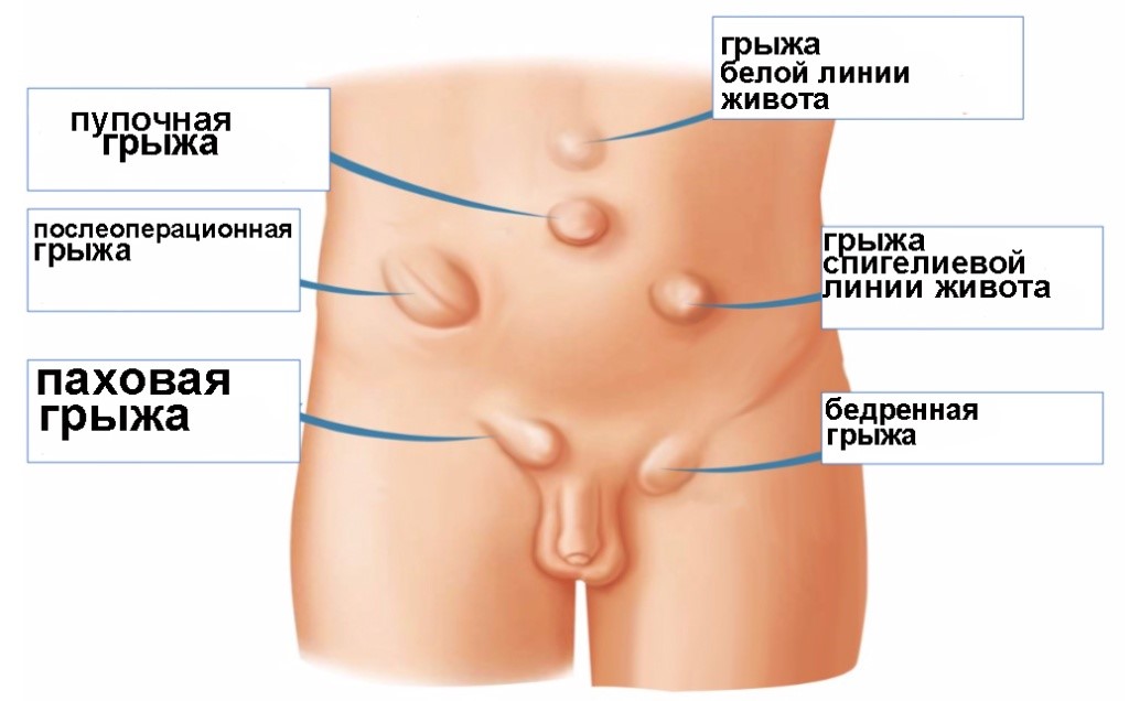 грыжи передней брюшной стенки
