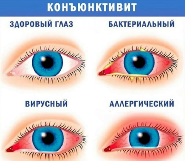 коньюктивит