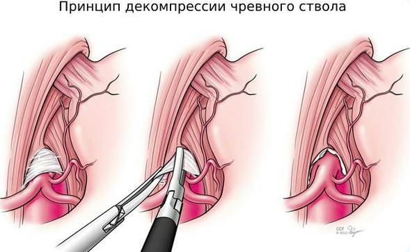 синдром данбара 08